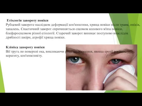 Етіологія завороту повіки Рубцевий завороте наслідком деформації кон'юнктиви, хряща повіки після