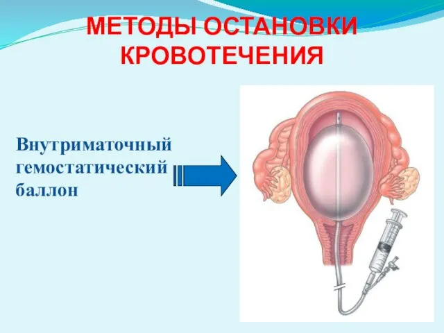 МЕТОДЫ ОСТАНОВКИ КРОВОТЕЧЕНИЯ Внутриматочный гемостатический баллон