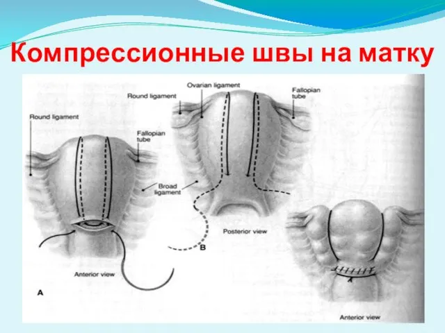 Компрессионные швы на матку