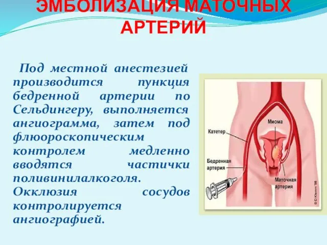 ЭМБОЛИЗАЦИЯ МАТОЧНЫХ АРТЕРИЙ Под местной анестезией производится пункция бедренной артерии по