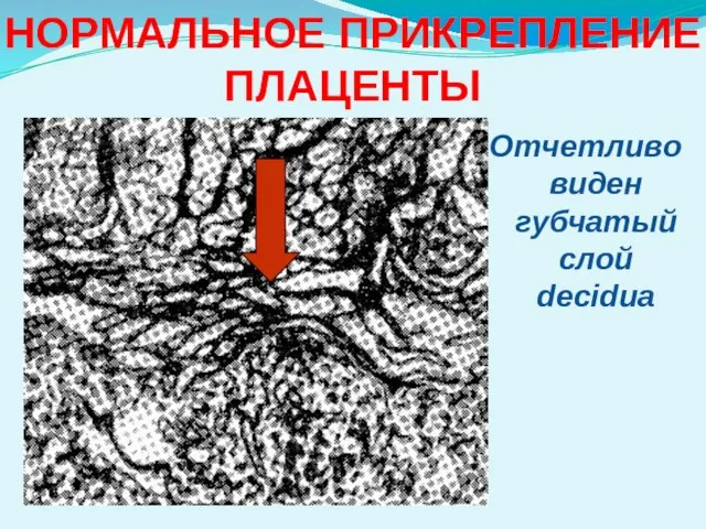 НОРМАЛЬНОЕ ПРИКРЕПЛЕНИЕ ПЛАЦЕНТЫ Отчетливо виден губчатый слой decidua