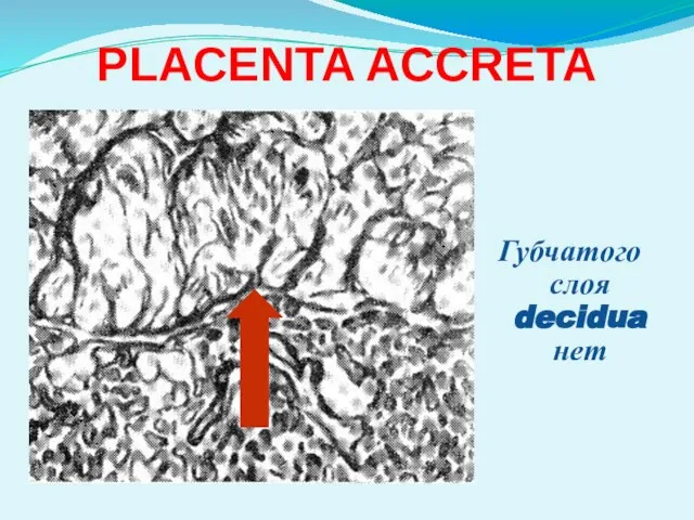 PLACENTA ACCRETA Губчатого слоя decidua нет