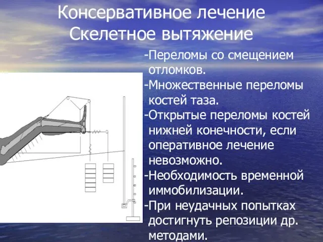 Консервативное лечение Скелетное вытяжение Переломы со смещением отломков. Множественные переломы костей