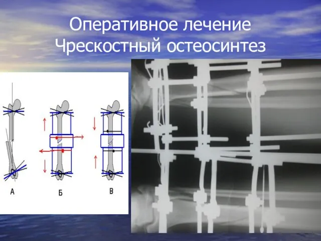 Оперативное лечение Чрескостный остеосинтез