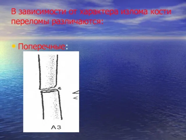 В зависимости от характера излома кости переломы различаются: Поперечные: