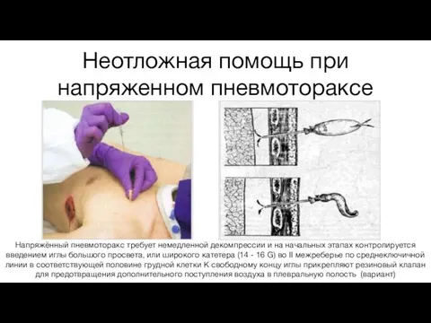 Неотложная помощь при напряженном пневмотораксе Напряжённый пневмоторакс требует немедленной декомпрессии и