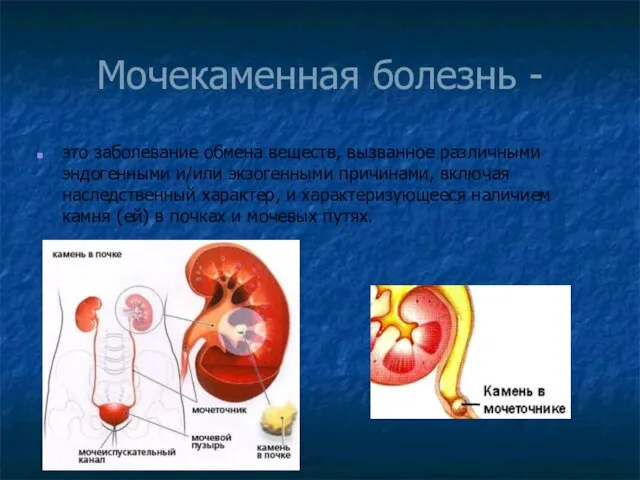 Мочекаменная болезнь - это заболевание обмена веществ, вызванное различными эндогенными и/или