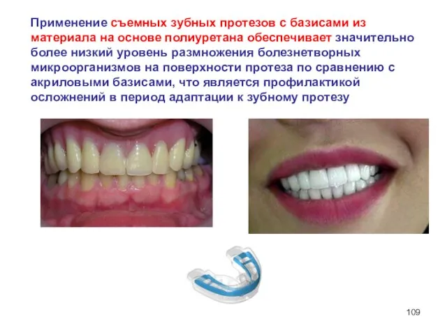 Применение съемных зубных протезов с базисами из материала на основе полиуретана