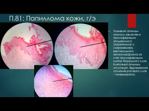 П.81: Папиллома кожи, г/э Тканевой атипизм опухоли заключен в пролиферации эпидермиса