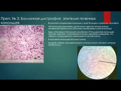 Преп. № 3: Баллонная дистрофия эпителия почечных канальцев Встречаются единичные канальцы