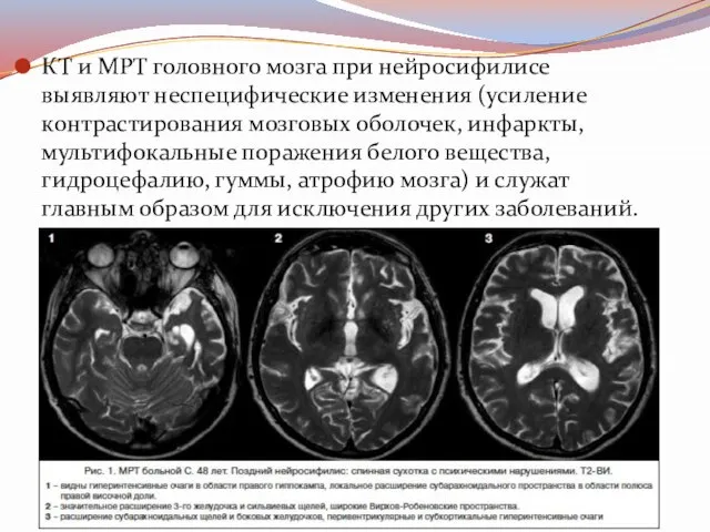 КТ и МРТ головного мозга при нейросифилисе выявляют неспецифические изменения (усиление