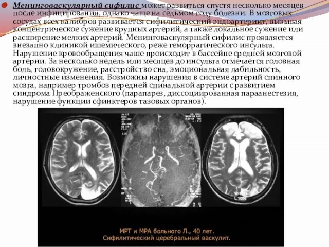 Менинговаскулярный сифилис может развиться спустя несколько месяцев после инфицирования, однако чаще