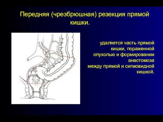 - Передняя (чрезбрюшная) резекция прямой кишки. удаляется часть прямой кишки, пораженной