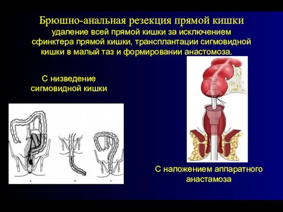 Брюшно-анальная резекция прямой кишки удаление всей прямой кишки за исключением сфинктера