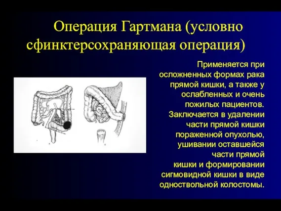 Операция Гартмана (условно сфинктерсохраняющая операция) Применяется при осложненных формах рака прямой