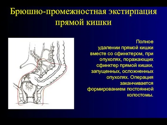 Брюшно-промежностная экстирпация прямой кишки Полное удалении прямой кишки вместе со сфинктером,