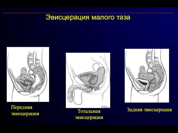 Эвисцерация малого таза Передняя эвисцерация Задняя эвисцерация Тотальная эвисцерация