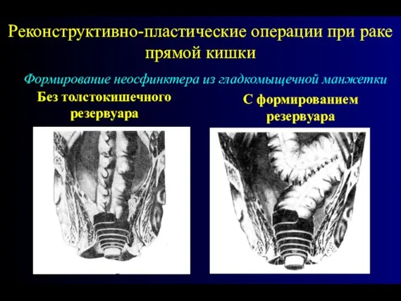 Реконструктивно-пластические операции при раке прямой кишки Формирование неосфинктера из гладкомыщечной манжетки