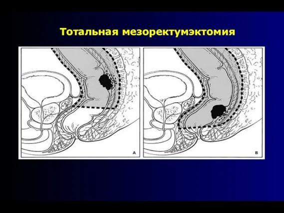 Тотальная мезоректумэктомия