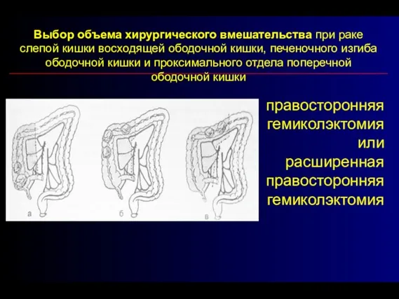 правосторонняя гемиколэктомия или расширенная правосторонняя гемиколэктомия Выбор объема хирургического вмешательства при