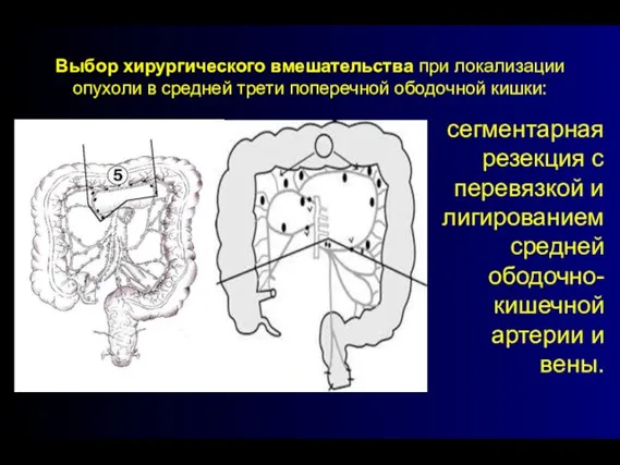 Выбор хирургического вмешательства при локализации опухоли в средней трети поперечной ободочной