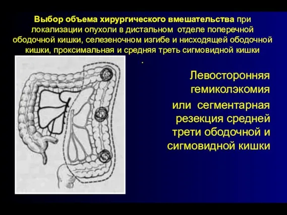 Выбор объема хирургического вмешательства при локализации опухоли в дистальном отделе поперечной