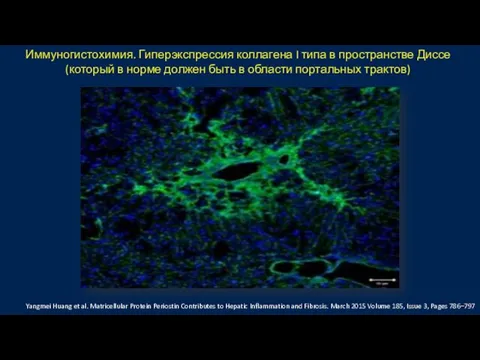 Иммуногистохимия. Гиперэкспрессия коллагена I типа в пространстве Диссе (который в норме