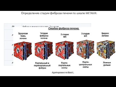 Определение стадии фиброза печени по шкале METAVIR: