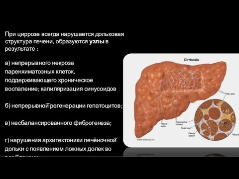 1 При циррозе всегда нарушается дольковая структура печени, образуются узлы в