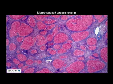 1 Мелкоузловой цирроз печени