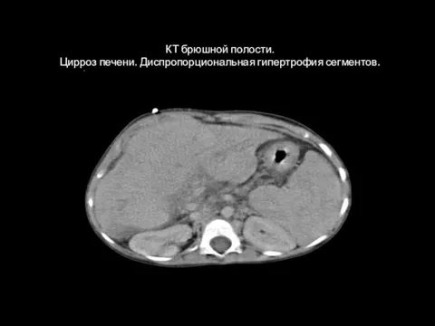 1 КТ брюшной полости. Цирроз печени. Диспропорциональная гипертрофия сегментов.