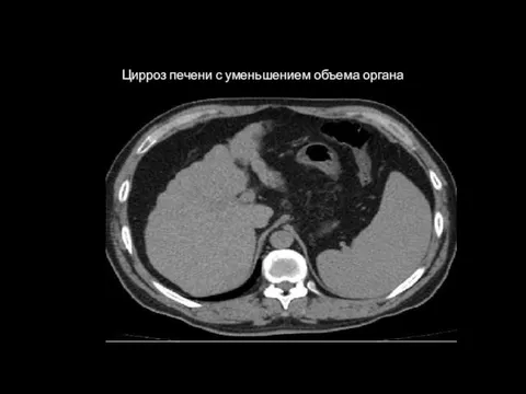 1 Цирроз печени с уменьшением объема органа