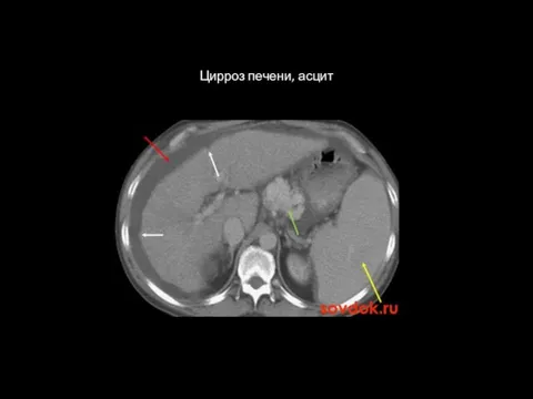 1 Цирроз печени, асцит