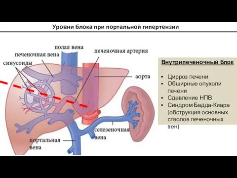 Уровни блока при портальной гипертензии Внутрипеченочный блок Цирроз печени Обширные опухоли