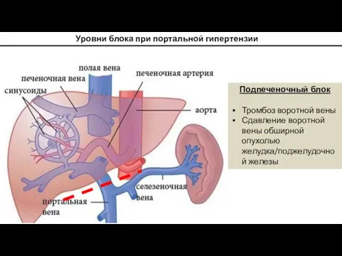 Уровни блока при портальной гипертензии Подпеченочный блок Тромбоз воротной вены Сдавление