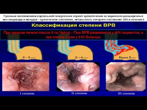 Грозным осложнением портальной гипертензии служит кровотечение из варикозно-расширенных вен пищевода и