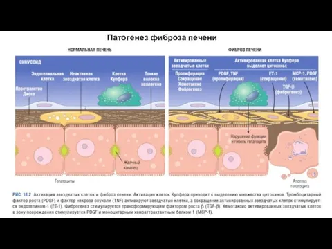 Патогенез фиброза печени