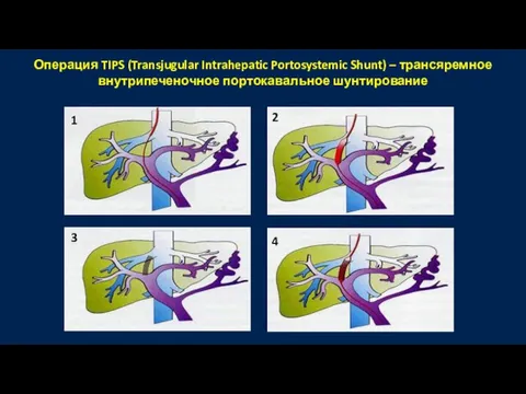 Операция TIPS (Transjugular Intrahepatic Portosystemic Shunt) – трансяремное внутрипеченочное портокавальное шунтирование 1 2 3 4