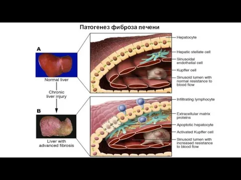 Патогенез фиброза печени