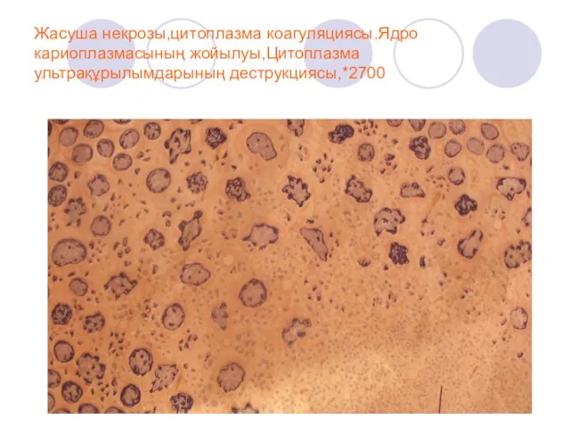 Жасуша некрозы,цитоплазма коагуляциясы.Ядро кариоплазмасының жойылуы,Цитоплазма ультрақұрылымдарының деструкциясы,*2700