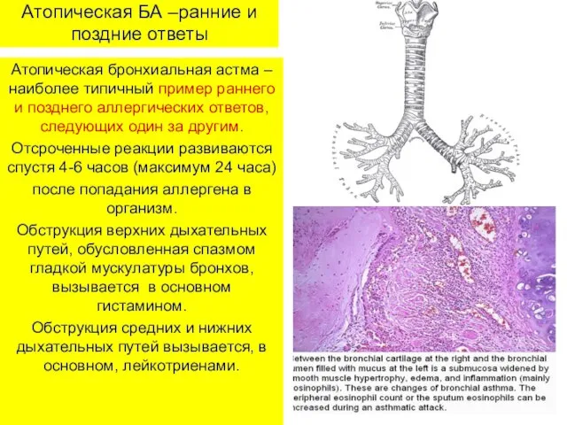 Атопическая БА –ранние и поздние ответы Атопическая бронхиальная астма – наиболее