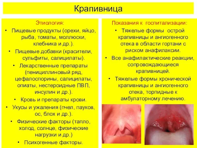 Крапивница Этиология: Пищевые продукты (орехи, яйцо, рыба, томаты, моллюски, клебника и