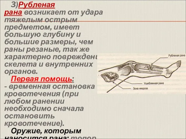 3)Рубленая рана возникает от удара тяжелым острым предметом, имеет большую глубину