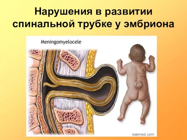 Нарушения в развитии спинальной трубке у эмбриона