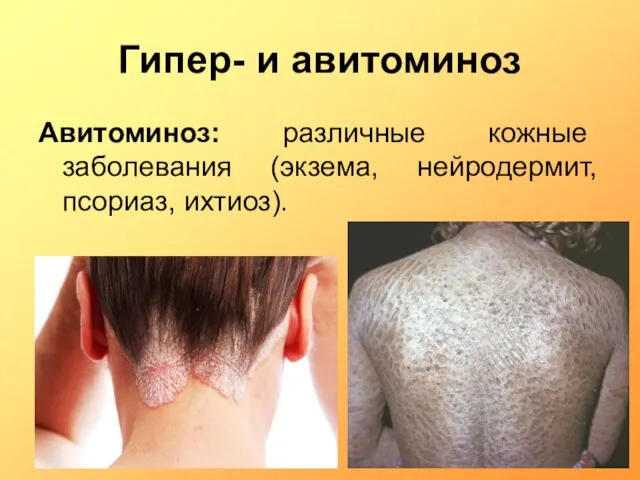 Гипер- и авитоминоз Авитоминоз: различные кожные заболевания (экзема, нейродермит, псориаз, ихтиоз).