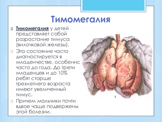 Тимомегалия Тимомегалия у детей представляет собой разрастание тимуса (вилочковой железы). Это