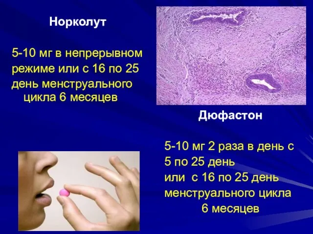 Норколут 5-10 мг в непрерывном режиме или с 16 по 25