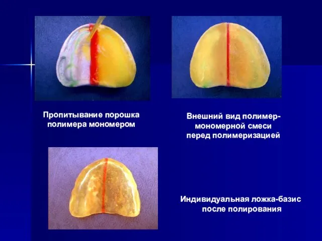 Пропитывание порошка полимера мономером Внешний вид полимер- мономерной смеси перед полимеризацией Индивидуальная ложка-базис после полирования