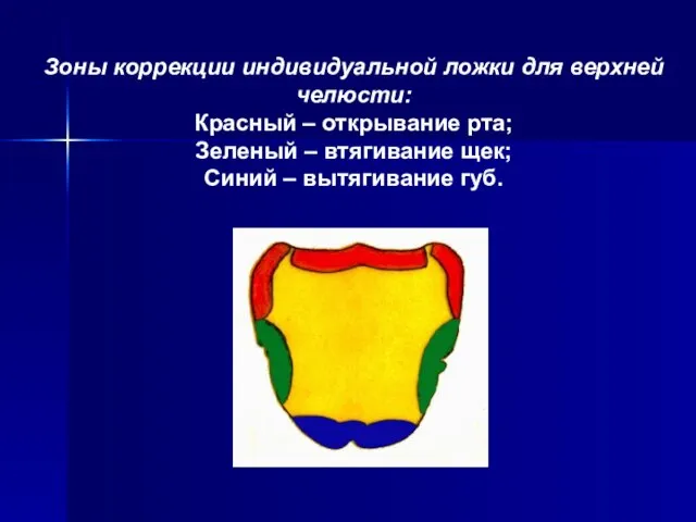 Зоны коррекции индивидуальной ложки для верхней челюсти: Красный – открывание рта;