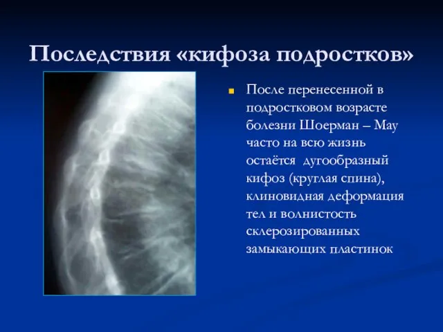 Последствия «кифоза подростков» После перенесенной в подростковом возрасте болезни Шоерман –